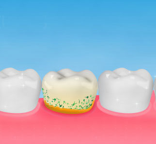 치아-플라크-염증