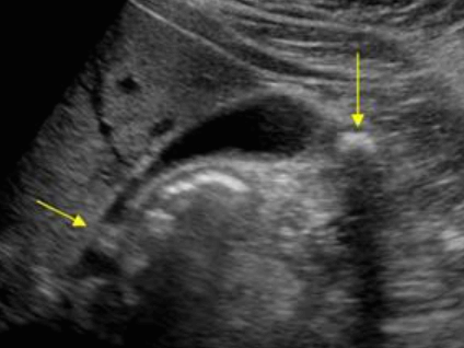 담석증 (Cholelitiasis = GB stone)