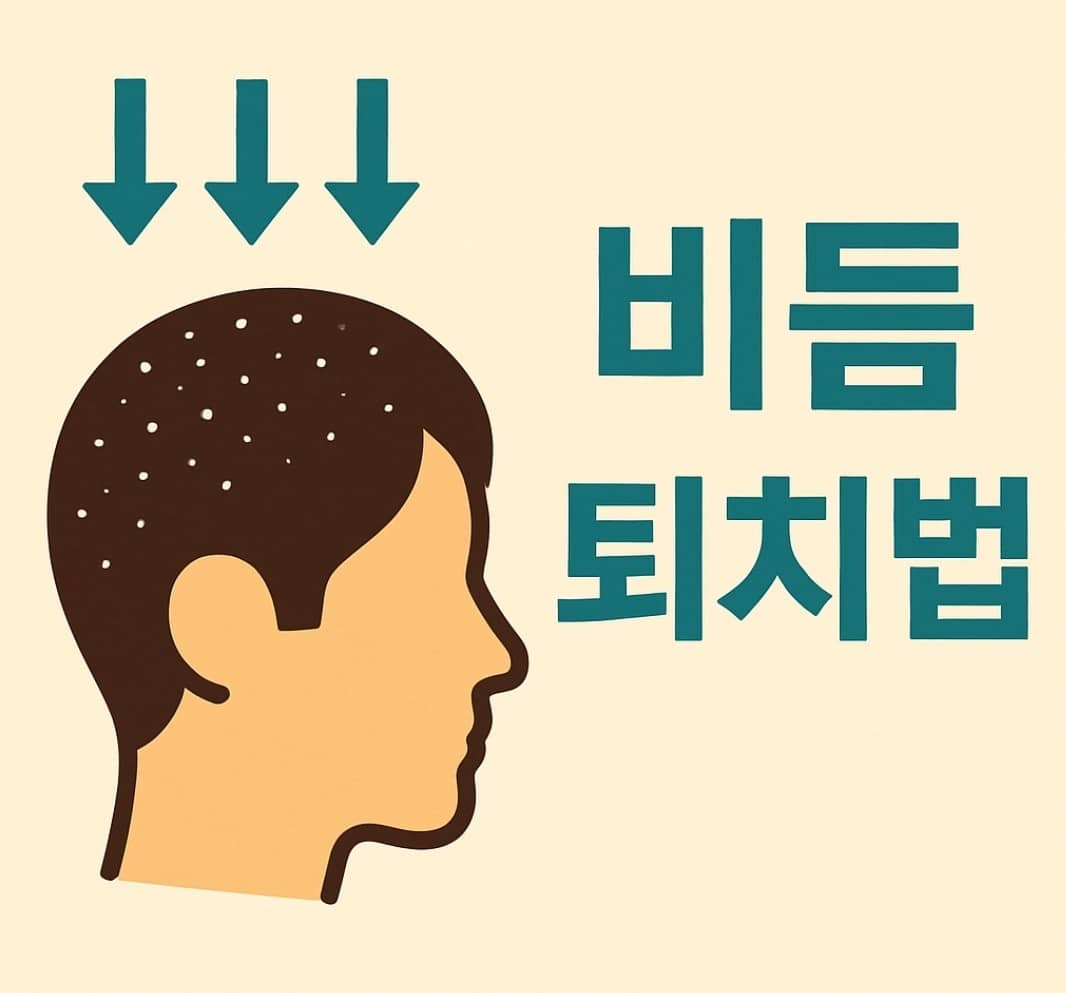 비듬 퇴치법