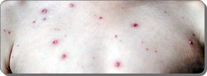 대상포진 초기증상 2