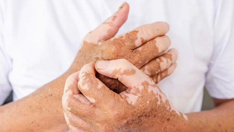 백반증 초기증상 원인 치료방법 총정리