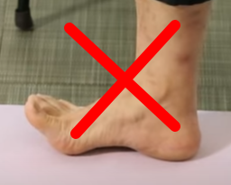 무지외반증 초간단 치료법&amp;#44; 무지외반증 교정기