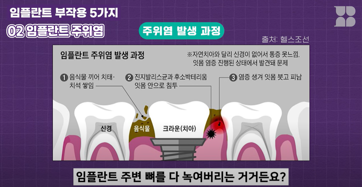 임플란트 주위에는 치주인대가 없어서 염증이 잘 생깁니다.