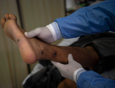 원숭이두창 바이러스 엠폭스(MPOX), 초기증상, 수포, 후유증, 치사율, 예방접종 등