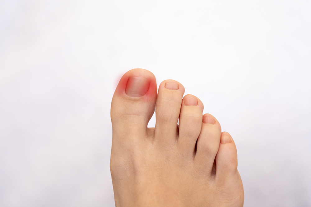 통풍에 좋은 음식