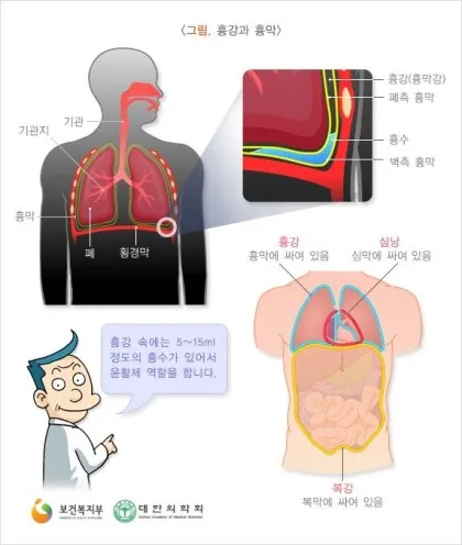 늑막에 물이 차는 이유와 치료 방법_8