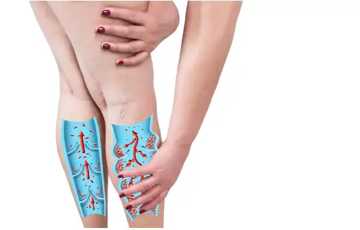 하지정맥류 초기 증상과 원인 치료방법