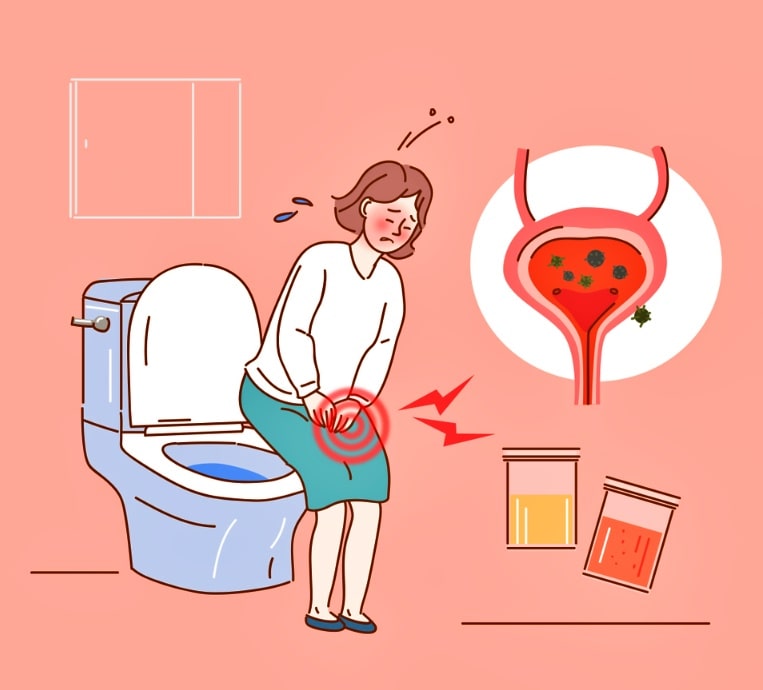 여성 방광염 증상