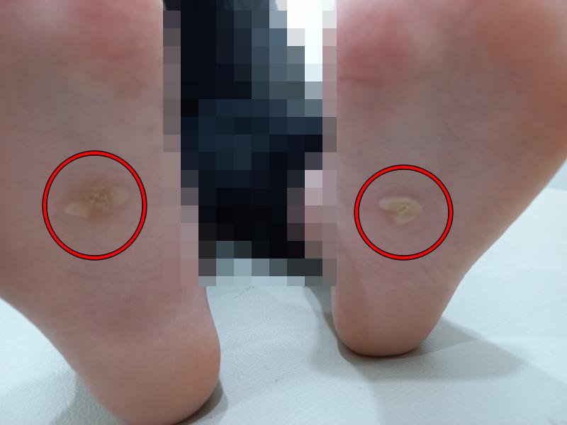 굳은살 냉동치로 3주차