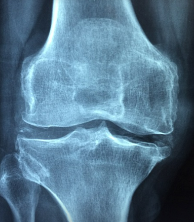 여성의 뼈 건강: 골다공증 예방과 관리