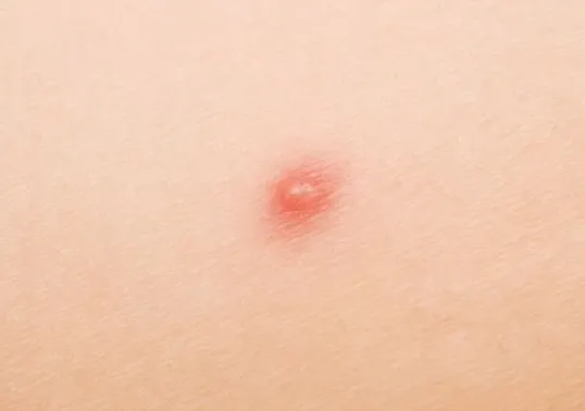 엉덩이 뾰루지 예방법