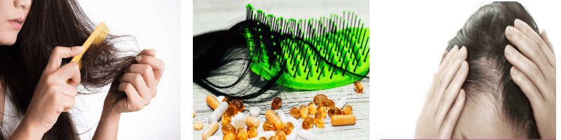 여성-탈모-사진