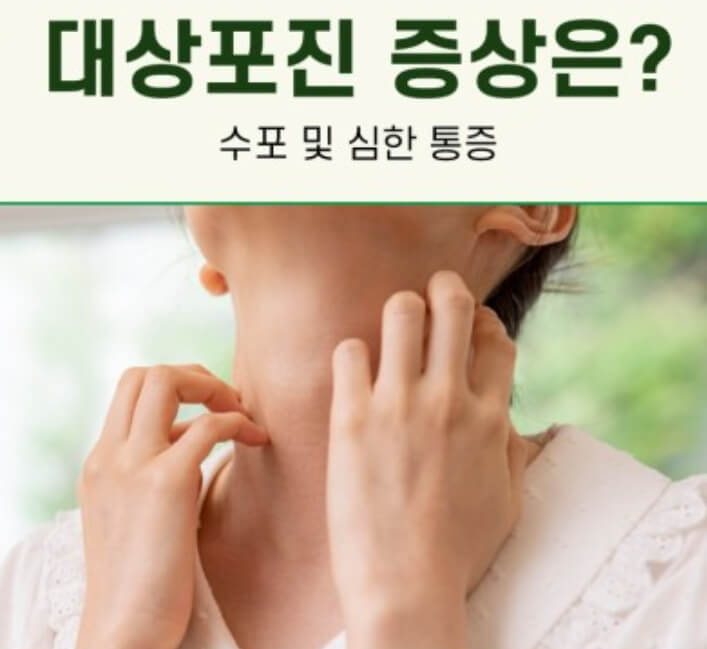 대상포진 증상