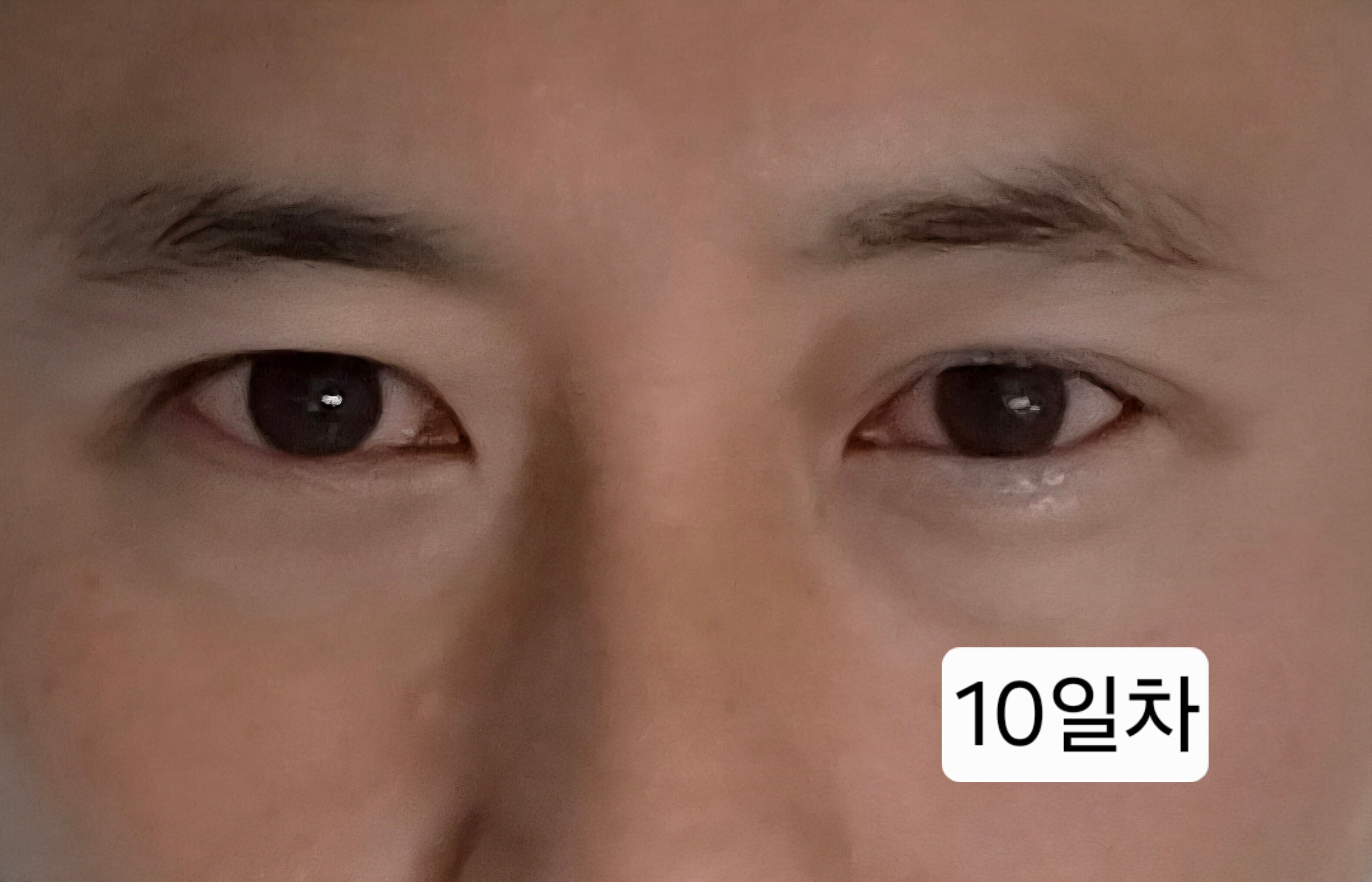 유행성각결막염 눈병 초기증상부터 12일차 치료 기록(진행 중)