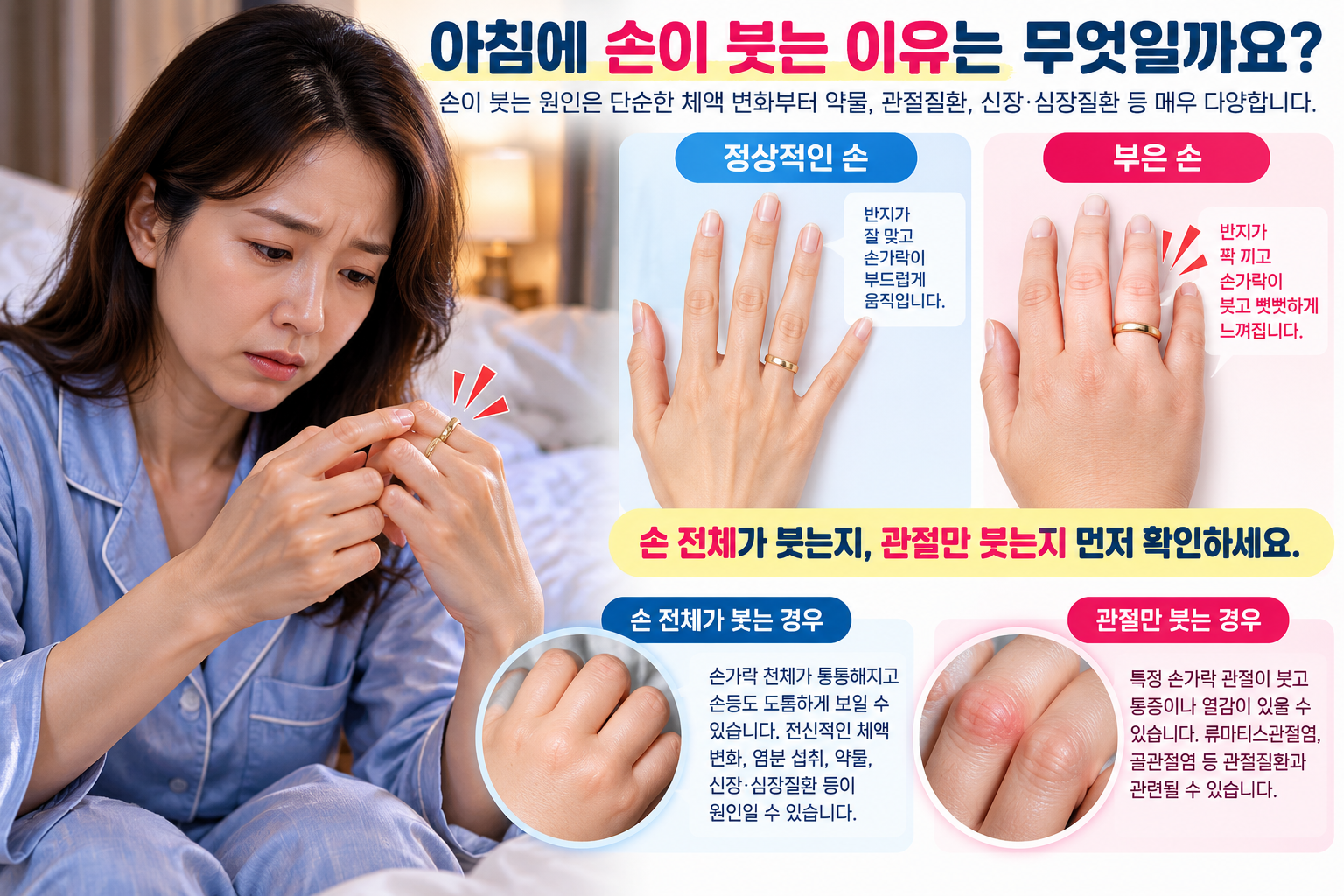 반지가 꽉 끼는 손과 손 전체 및 관절 부종을 비교한 설명 그림