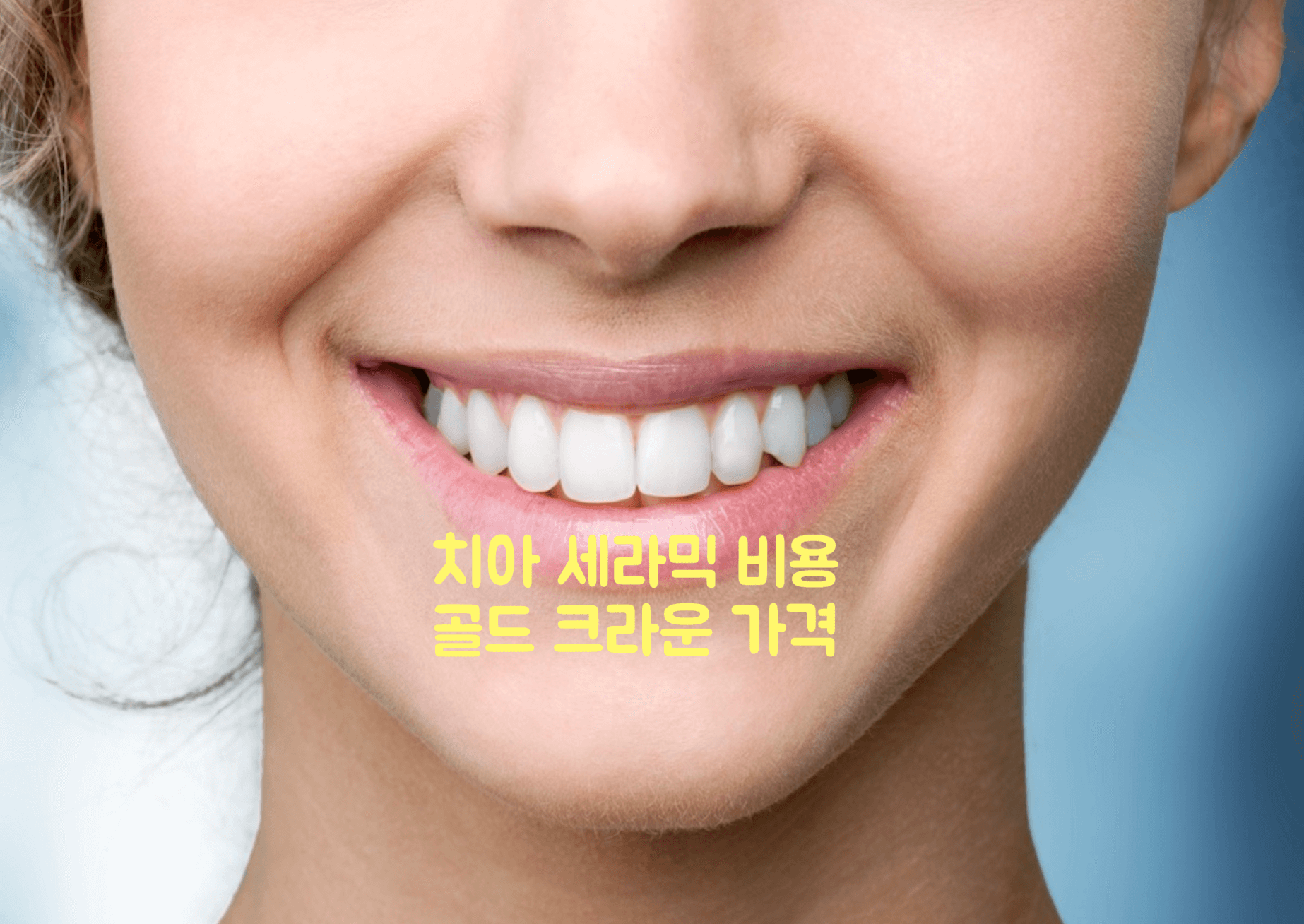 치아 세라믹 비용