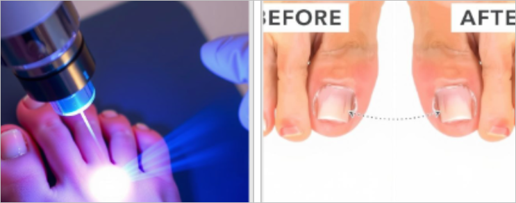 발톱무좀 치료, 어떻게 해야 할까? 레이저치료