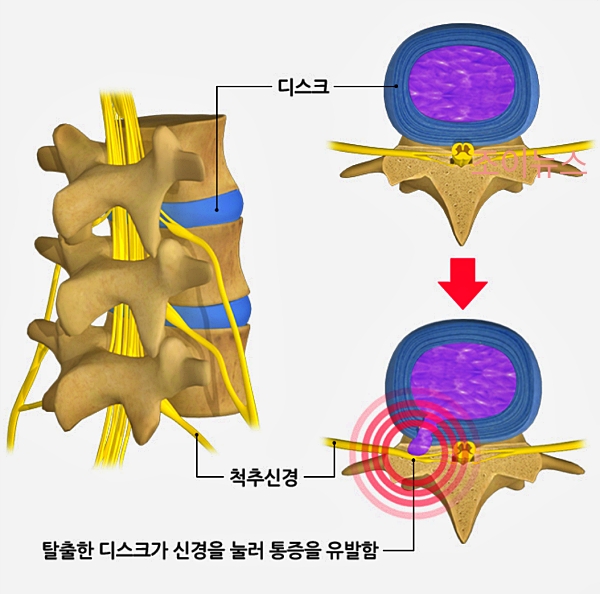 목 디스크, 어깨 통증 표로 구분하기_출처:질병관리청