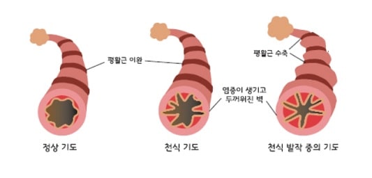 천식 증상 시, 기도 모양 (정상, 천식 기도, 천식 발작 기도)