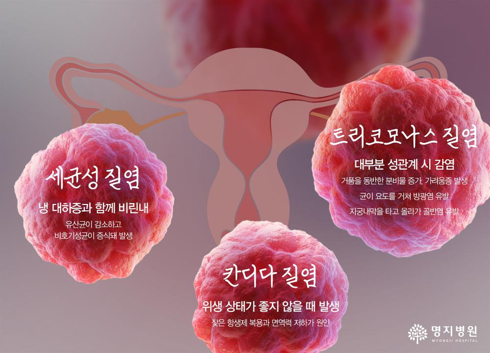 질염 증상