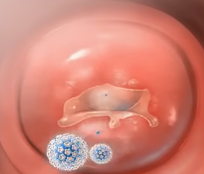 hpv 바이러스 원인