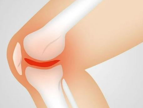 요산수치 낮추는 법 정상범위 통풍 원인