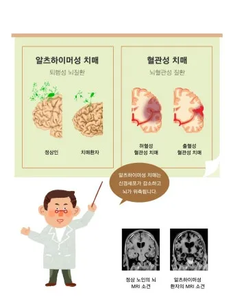 혈관성치매 원인 증상 치료법과 예방 생활습관_2