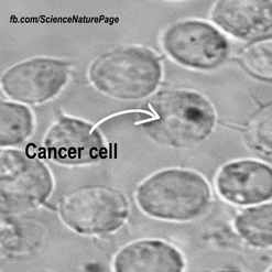 Cancer