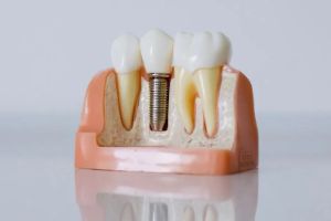 오산시-임플란트-치과-가격-비용-싼-곳,저렴한-곳,잘하는-곳,유명한-곳-BEST20-추천13