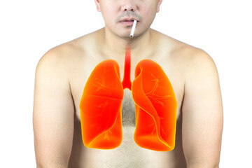 폐결절 원인 및 증상을 알아봤습니다. 폐결절이라는 말은 좀 생소한데요. 물론 폐결절 모두가 암으로 변하진 않지만 마땅한 전조증상이 없기 때문에 더욱 질병에 대해 숙지해야 합니다. 