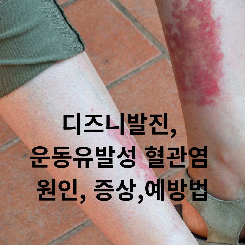 디즈니발진, 운동유발성 혈관염 원인, 증상,예방법