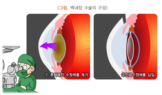 백내장