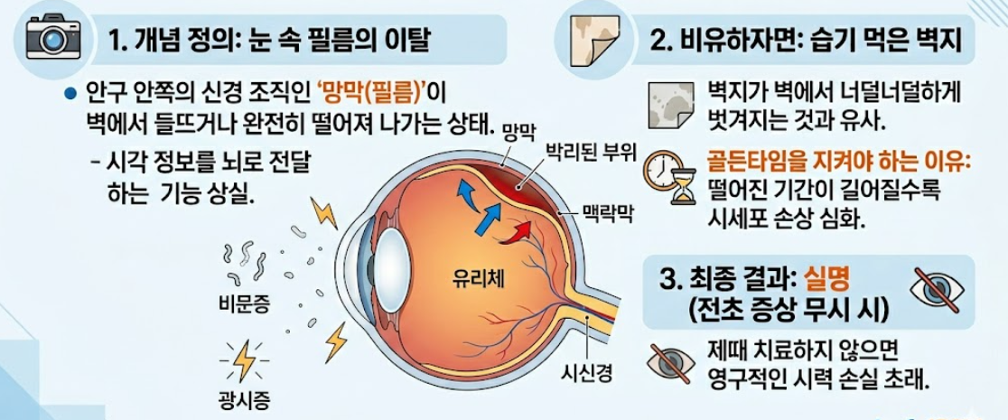망막 박리 증상