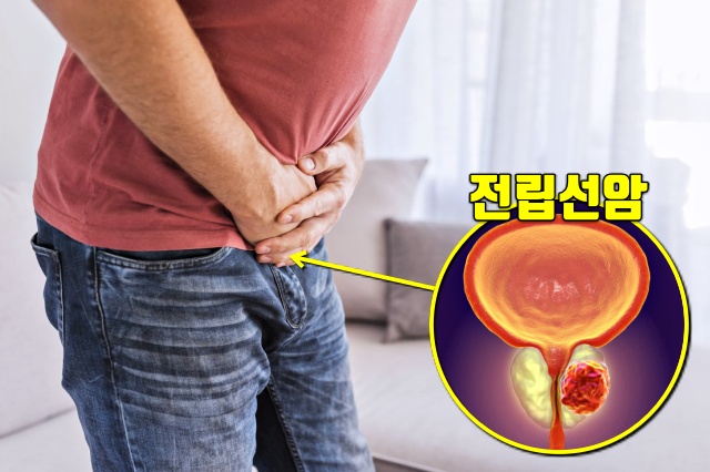 하루 소변횟수, 놓치기 쉬운 암 증상 7가지, 전립선암 증상 원인, 건강, 팁줌 매일꿀정보
