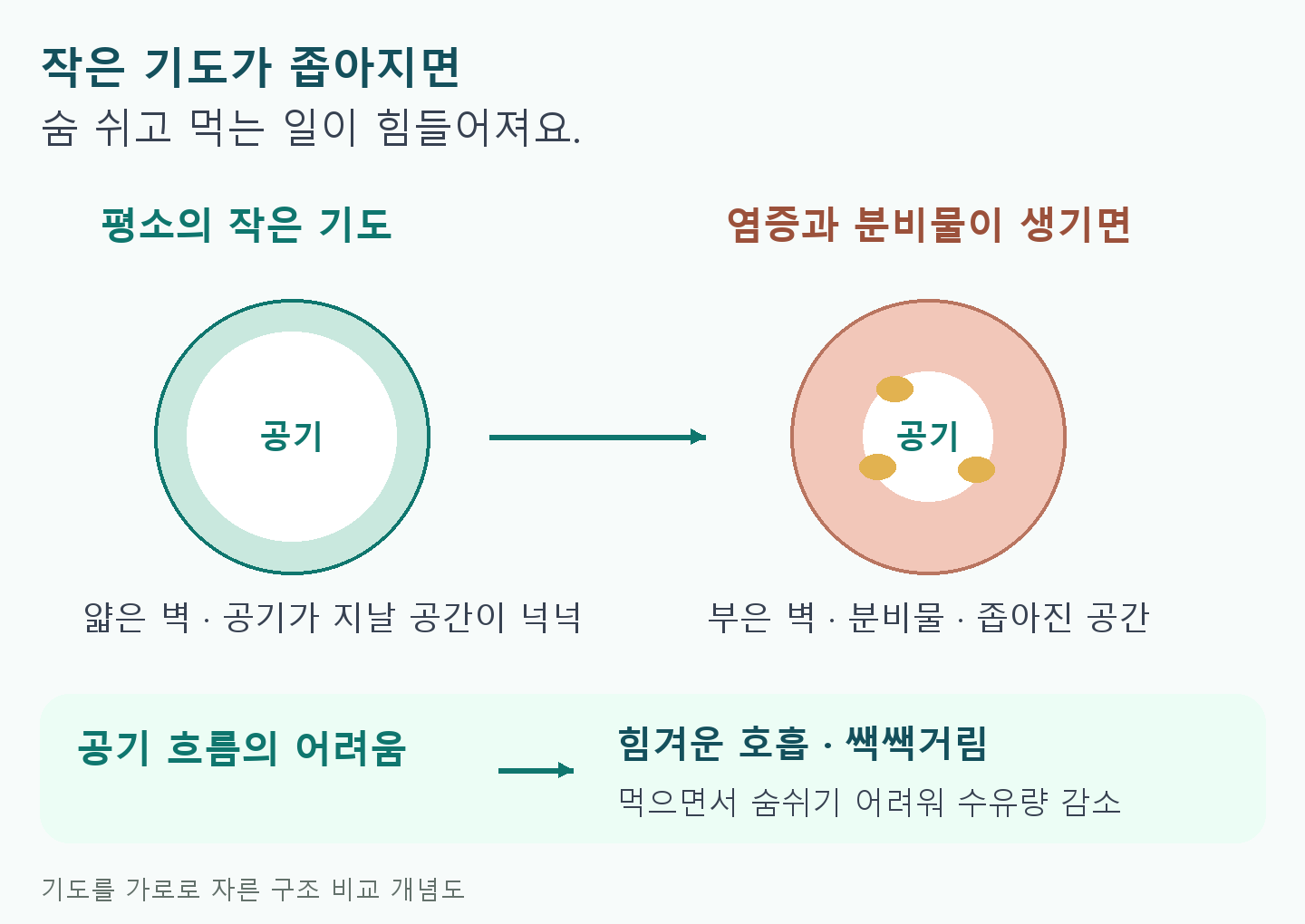 작은 기도의 단면 비교. 평소에는 얇은 벽 안쪽으로 공기가 지나며, 염증으로 벽이 붓고 분비물이 늘면 공기가 지날 공간이 줄어든다. 이 때문에 호흡과 수유가 어려워질 수 있다.