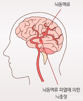 뇌동맥류