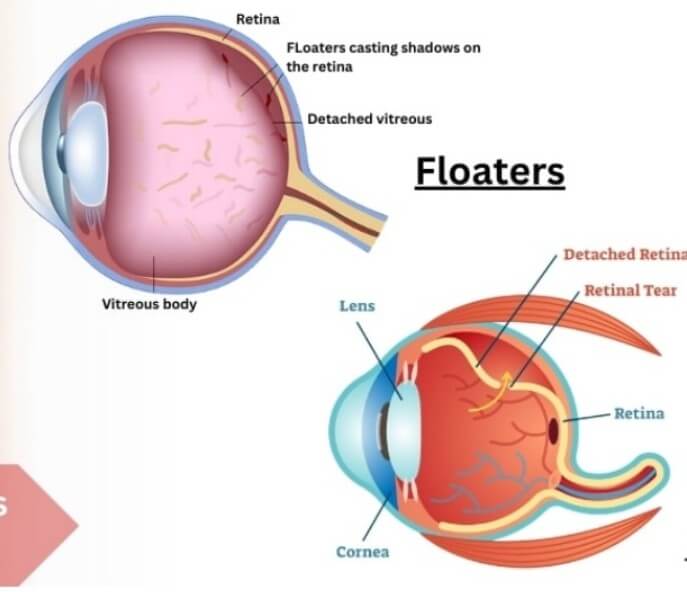 비문증에 대해서 설명하는 그림