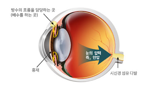  녹내장 수술 및 초기증상 