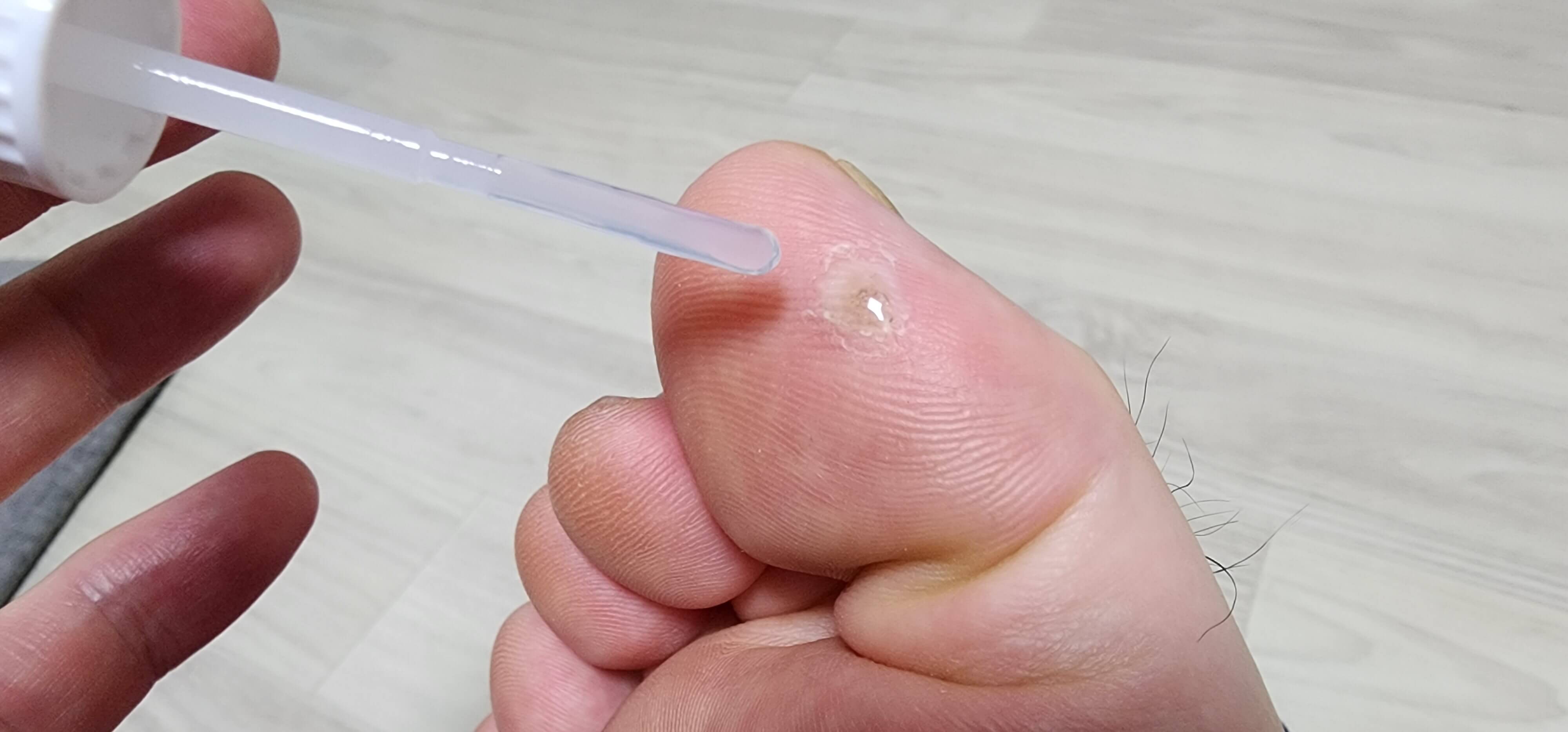 그린 티눈액 사마귀에 바르는 사진