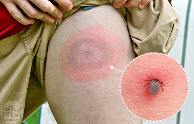 살인진드기 물린자국 구별,건강