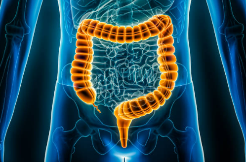 대장암의원인과증상