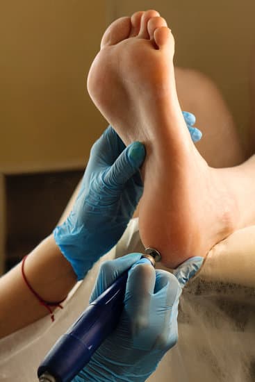 하얗게 일어난 발각질 제거하는 방법