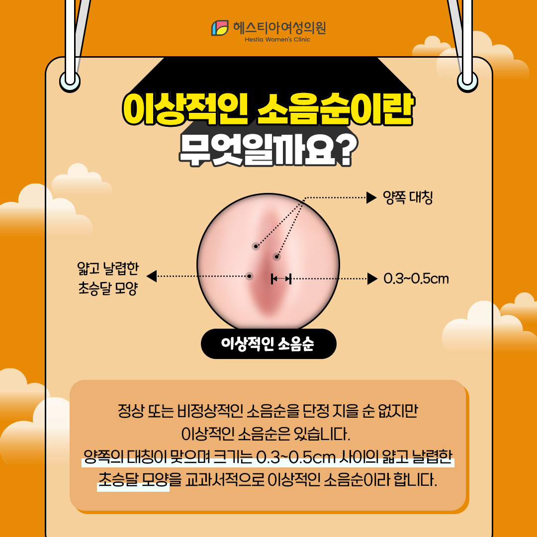 이상적인 소음순이란 무엇일까요?