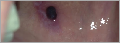 입안 피멍울 원인 치료방법