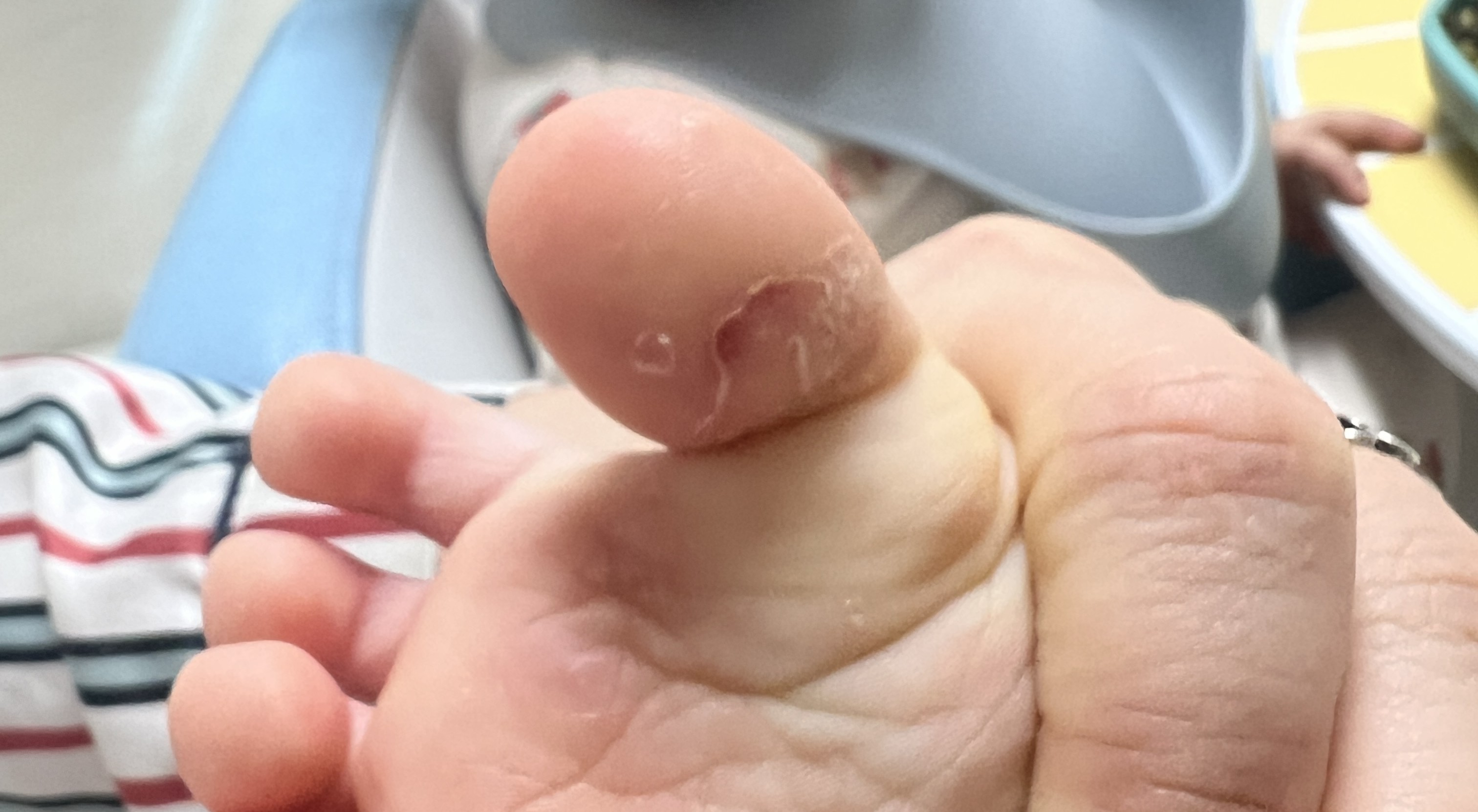 아이 발바닥 발진과 습진