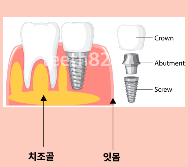 치조골-뼈이식-이란?