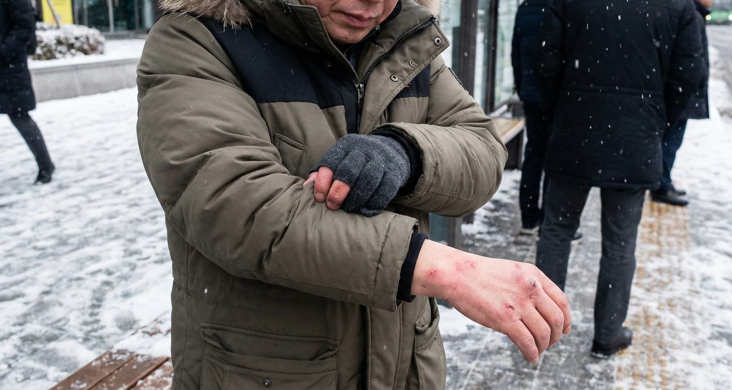 가려움이 심한 부위를 관리하는 겨울철 아토피 관리 보습 방법