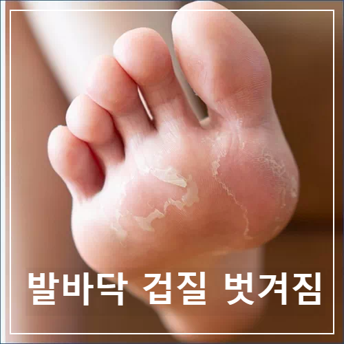 발바닥 껍질 벗겨짐
