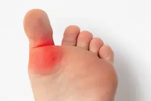 통풍