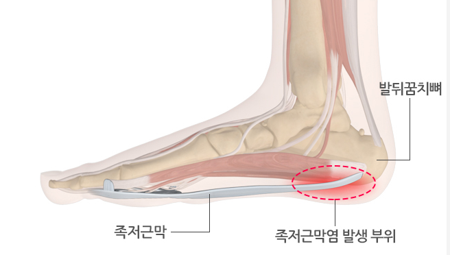 족저근막염 관련 사진